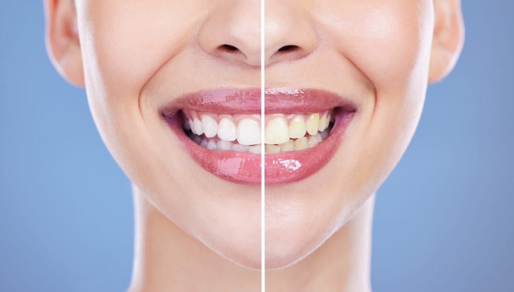 Thinking About Whitening Your Teeth? What to Know Before You Start