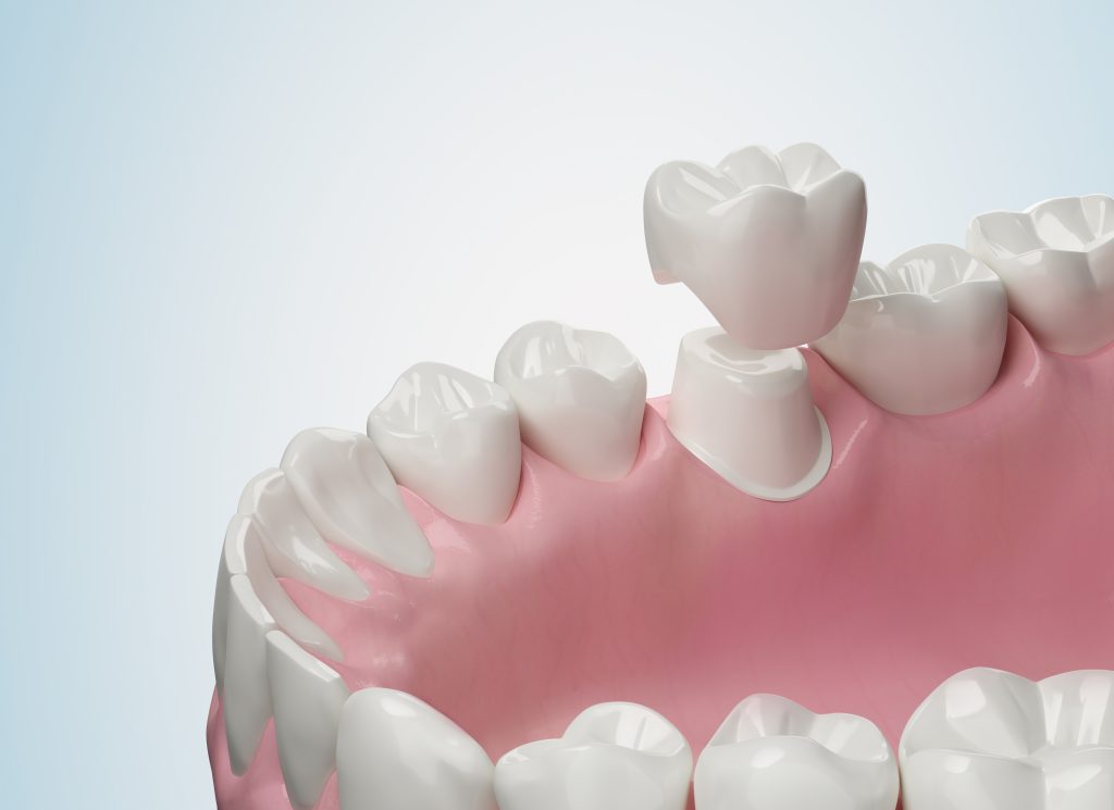 Filling or Crown? How We Decide What Your Tooth Needs